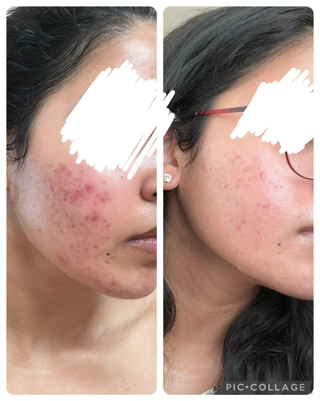 ANUA Azelaic Acid 10 Hyaluron Redness Soothing Serum